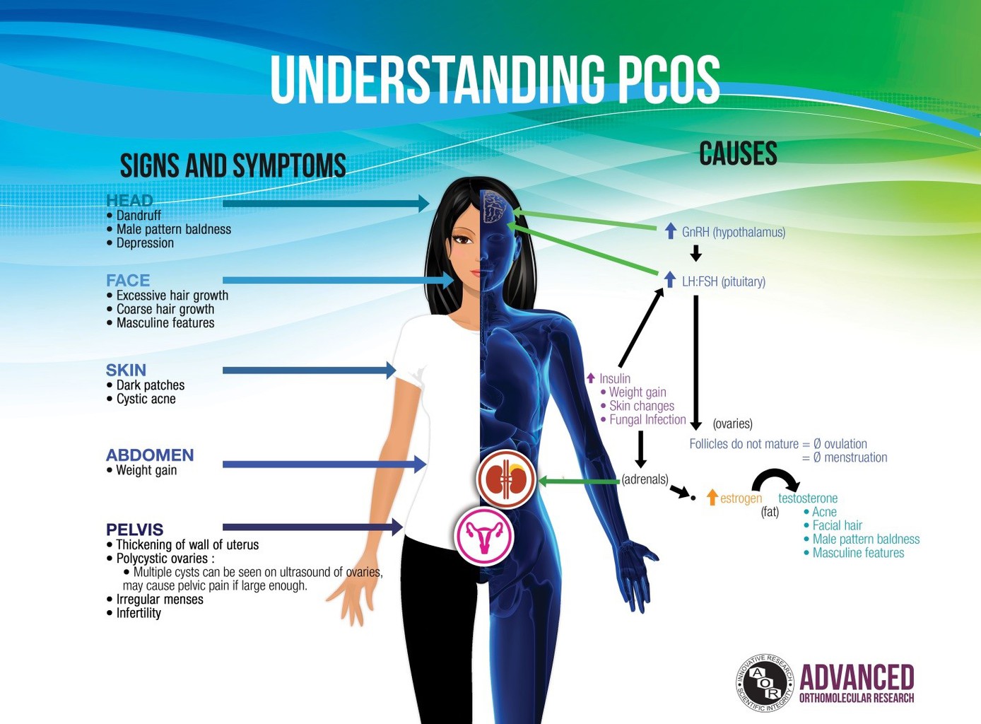 Mengenal PCOS, Gangguan Hormonal yang Menyebabkan Sulit Hamil